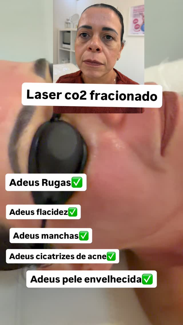 Bodylaser_oficial Facebook ad: Renove a sua pele com o Laser CO₂…
