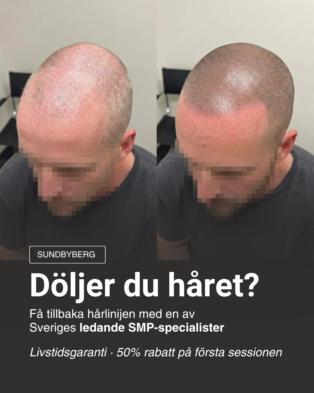 Scalp Micropigmentation Capillos Facebook ad: Påverkar håret ditt självförtroende?
