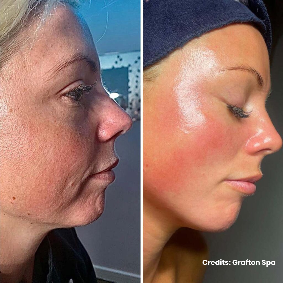 The Chartham Skin & Medical Aesthetics Clinic Facebook ad: NeoGen | Non-Surgical Skin Tightening | Now Only £450…
