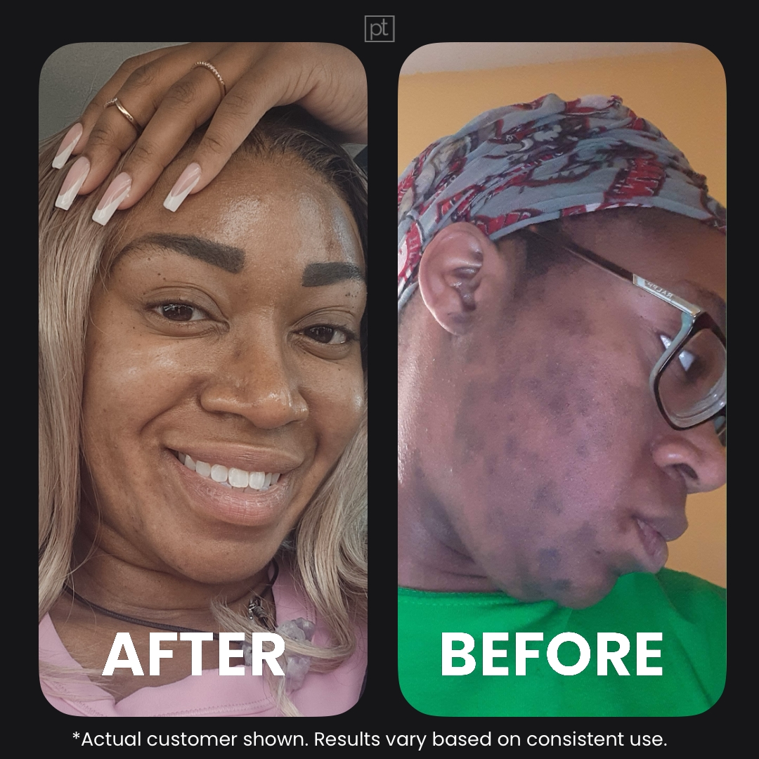 Perfec-Tone Facebook ad: Let Us Handle Your Skin