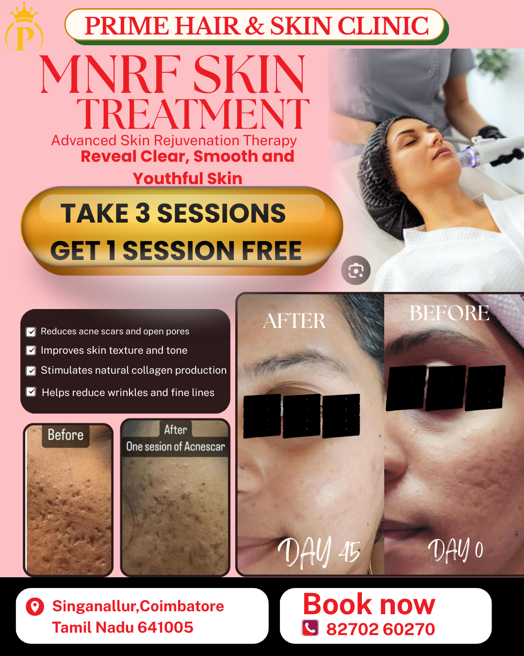 Prime hair and skin Clinic Facebook ad: MNRF Skin Treatment Take 3 Sessions, Get 1 Free