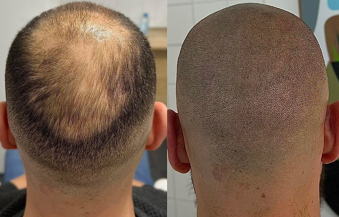 LC Scalp Micropigmentation Cyprus Facebook ad: Super natural healed result