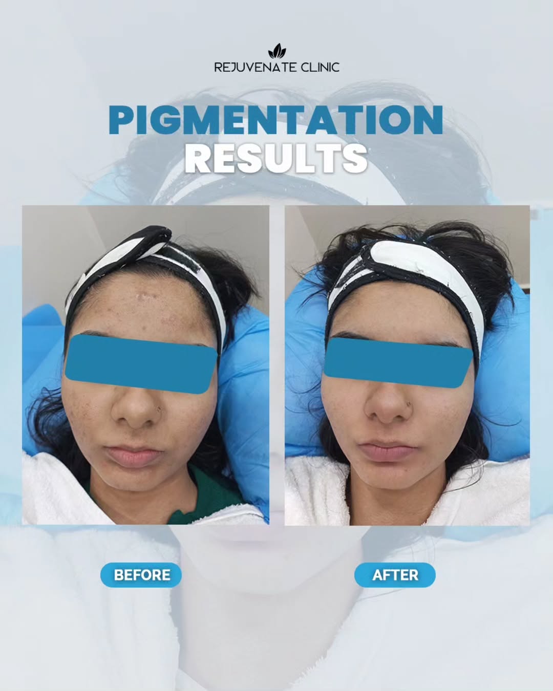 Rejuvenate Clinic Facebook ad: Concerned about pigmentation, melasma, or uneven skin tone?