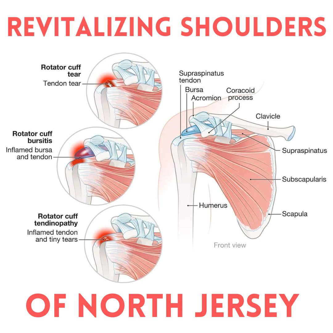 RX Physical Therapy Facebook ad: $67 Complete Shoulder Assessment And Plan