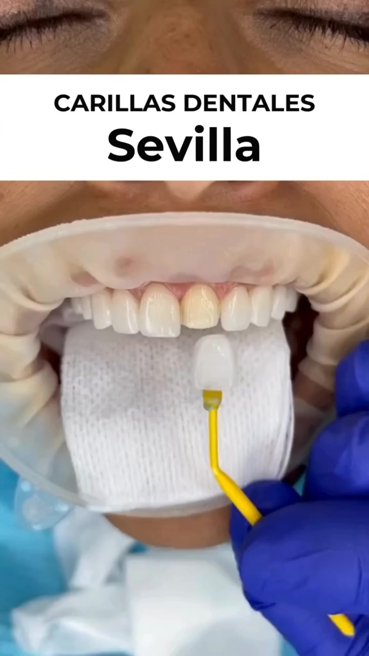 On Clinica Dental Facebook ad: Carillas de composite en Sevilla