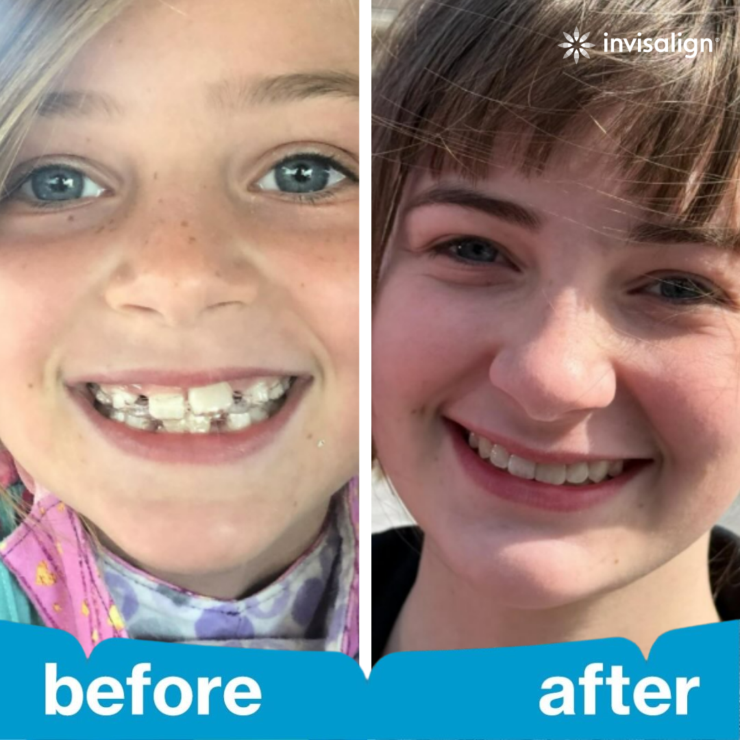 Invisalign Facebook ad