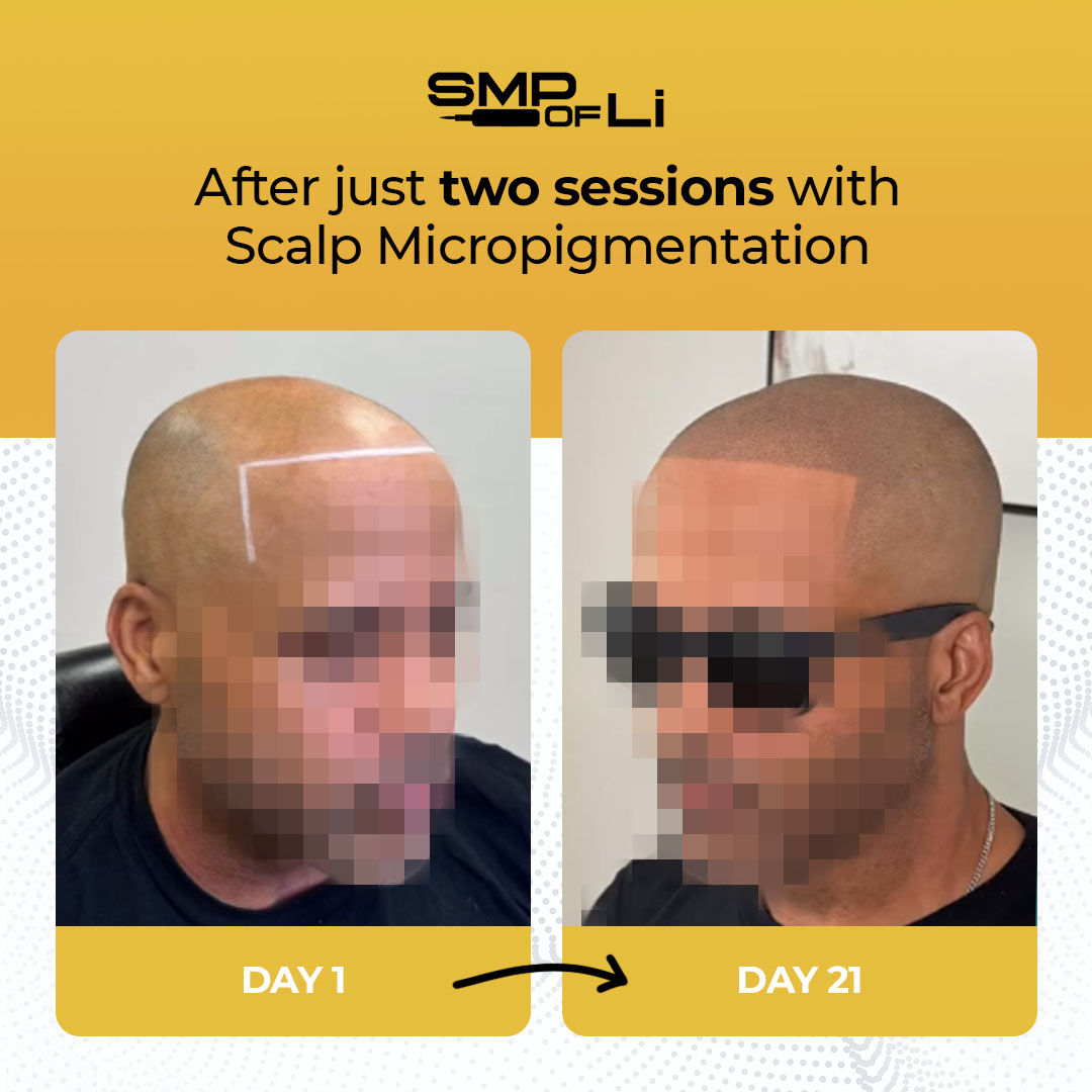Smpofli Facebook ad: New York, 15% Off Scalp Micropigmentation