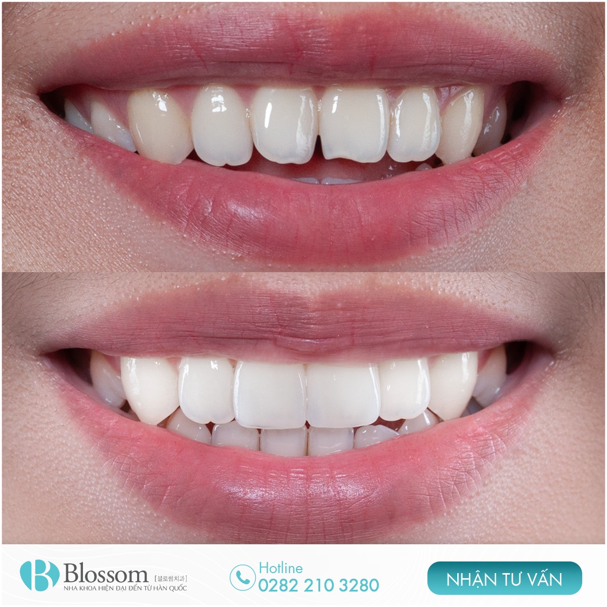 Blossom Dental Clinic - Nha Khoa Công Nghệ Cao Hàn Quốc Facebook ad