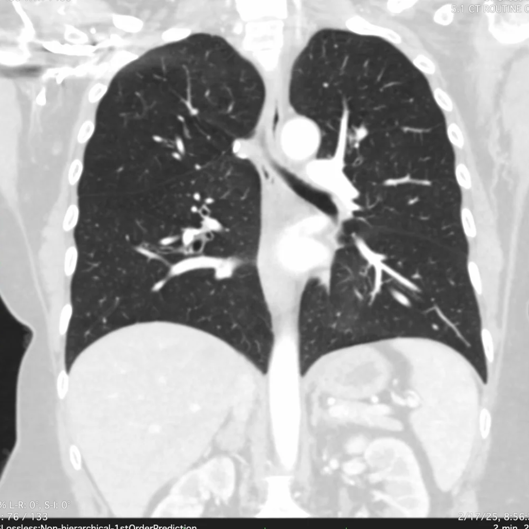 Dr. James Keller Facebook ad: Read this if your FEV1 keeps dropping