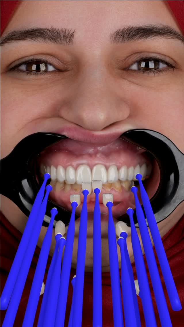 ד״ר רוכון עתאמנה Dr. Rokon Atamna Facebook ad: Smile design by dental veneers, gingivectomy and implants