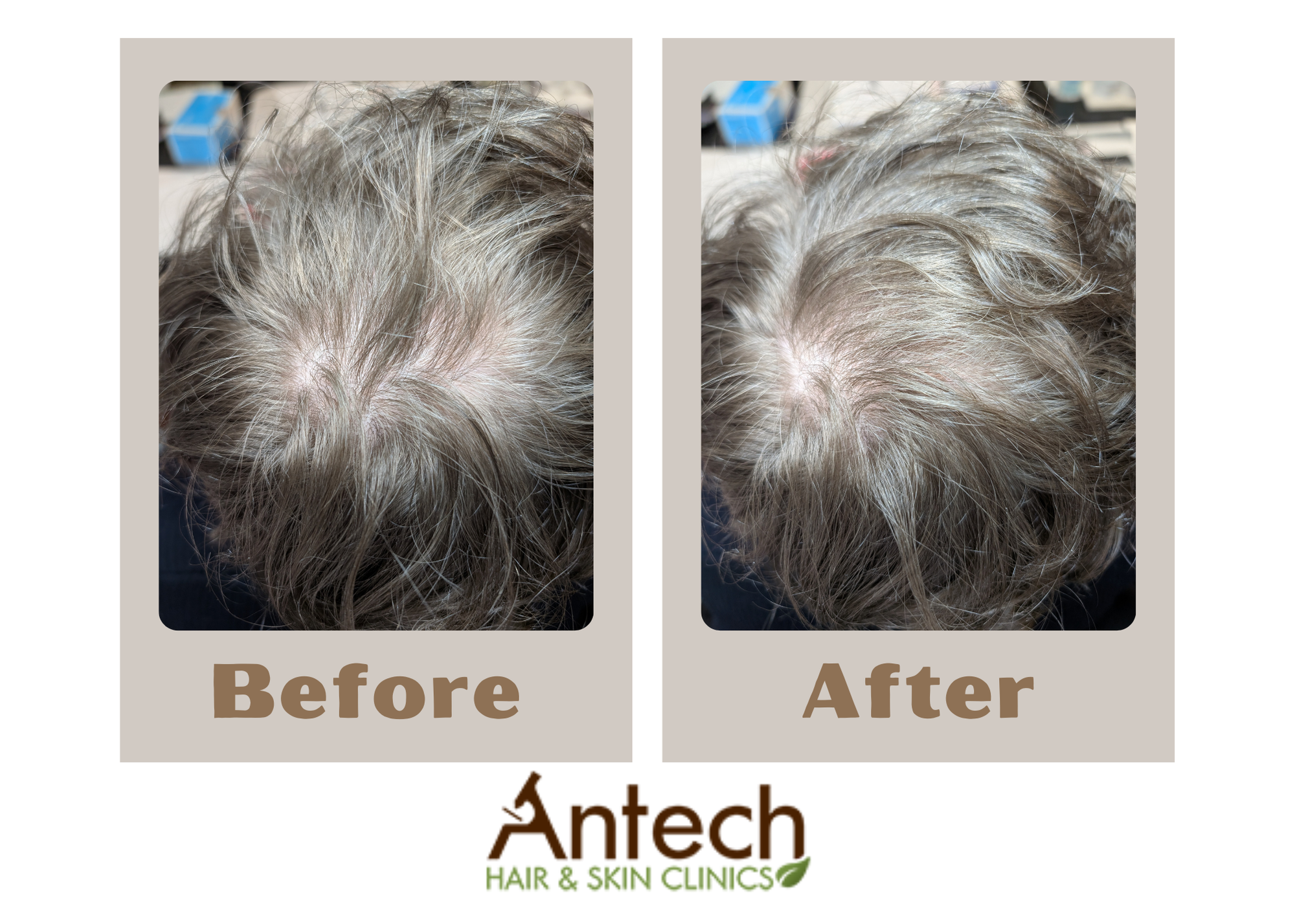 Antech Hair & Skin Clinic Facebook ad