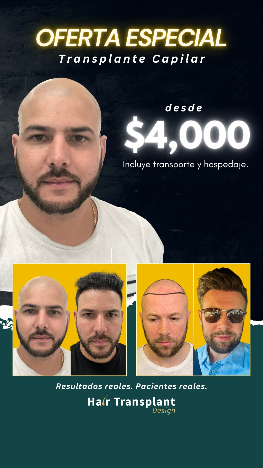 Hair Transplant Design Facebook ad