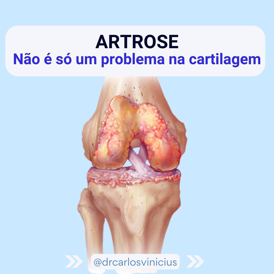Dr. Carlos Vinícius Ortopedista de Joelho, Esporte e Dor nas articulações Facebook ad: Artrose não é só um problema na cartilagem.