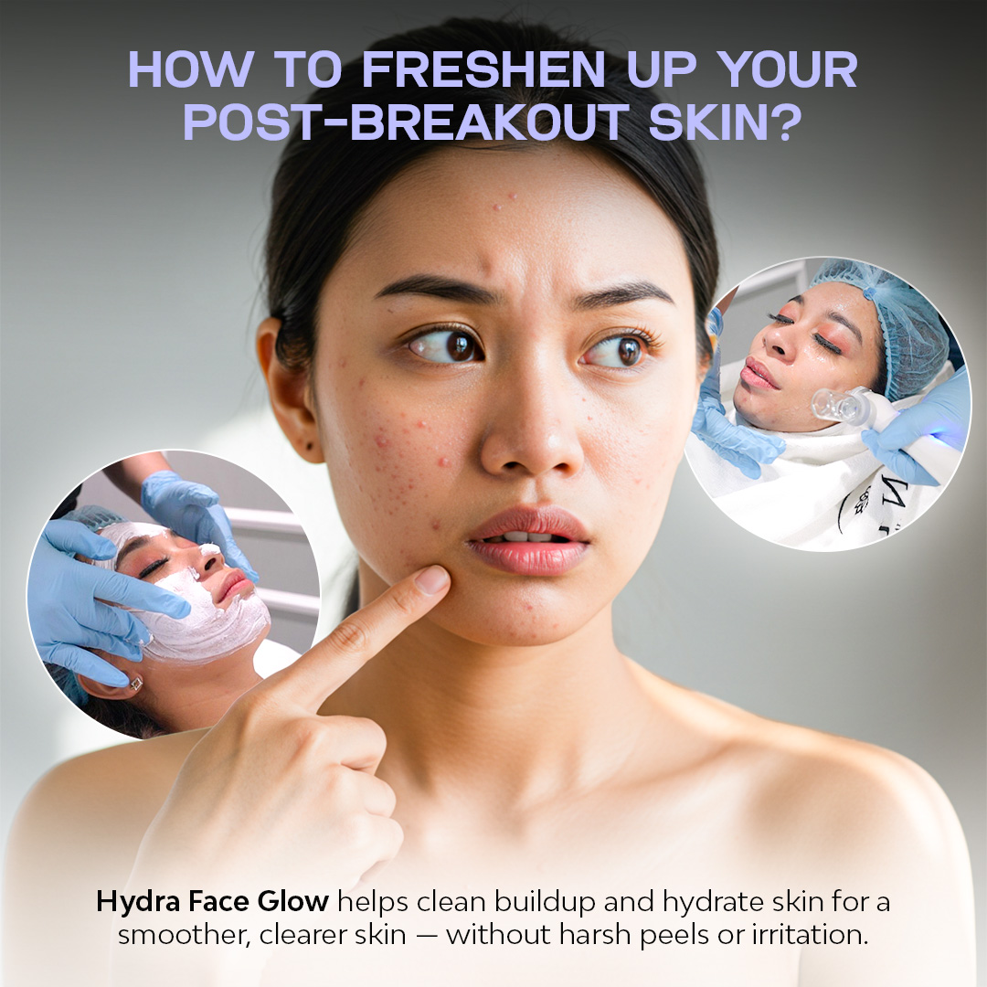 Venus Aesthetics.PH Facebook ad: Hydra Face Glow | P599