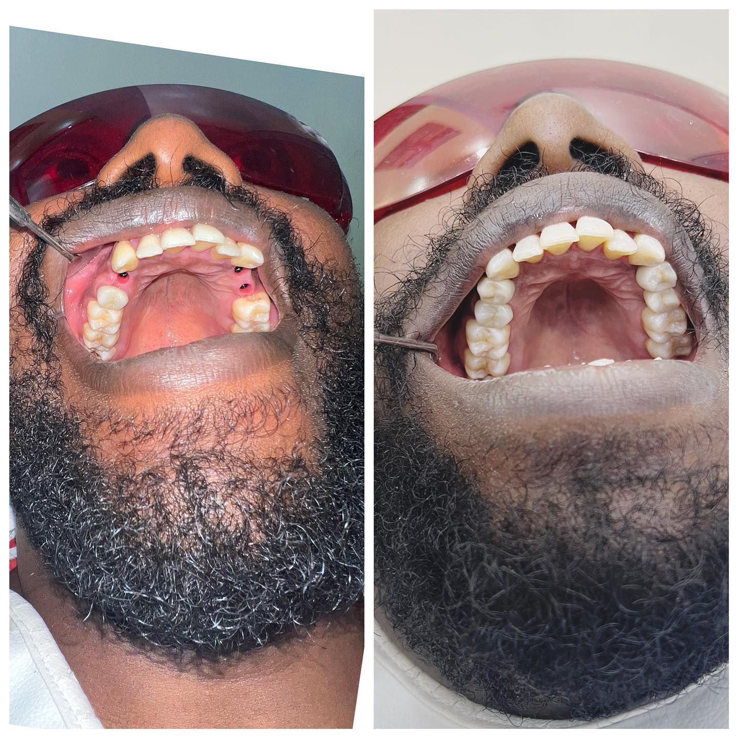 Deans Dental Implants Facebook ad: A new smile, a new chapter
