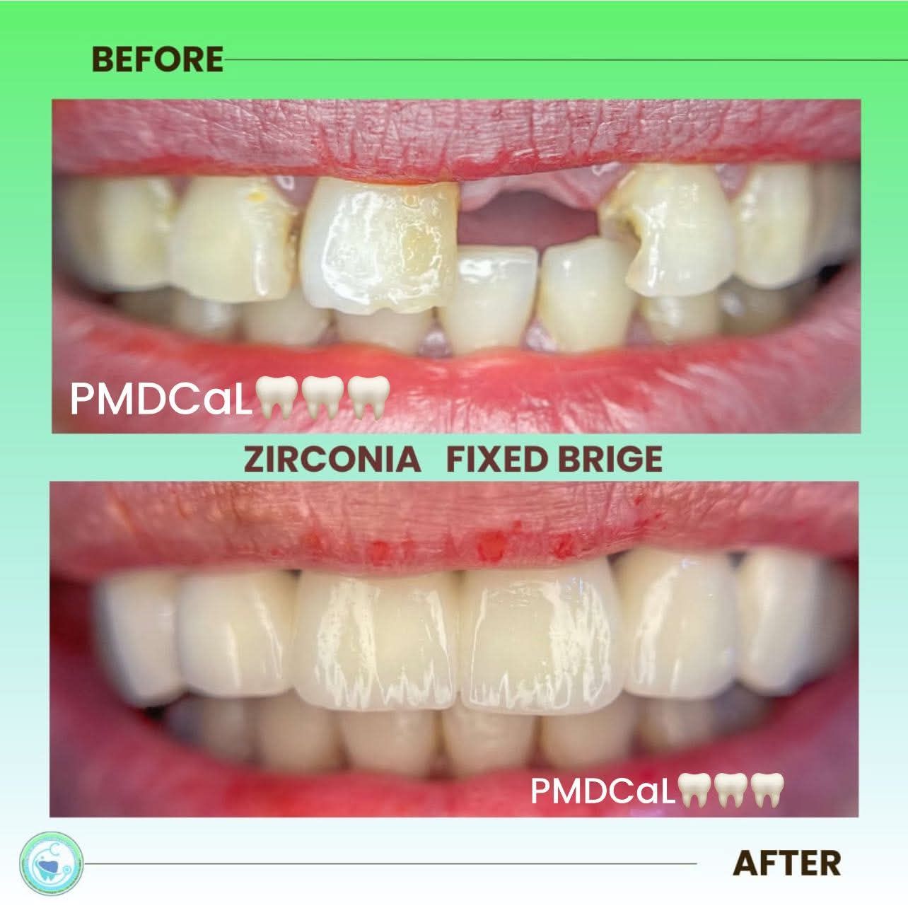 PMDCal Pampanga Facebook ad: Zirconia Upper