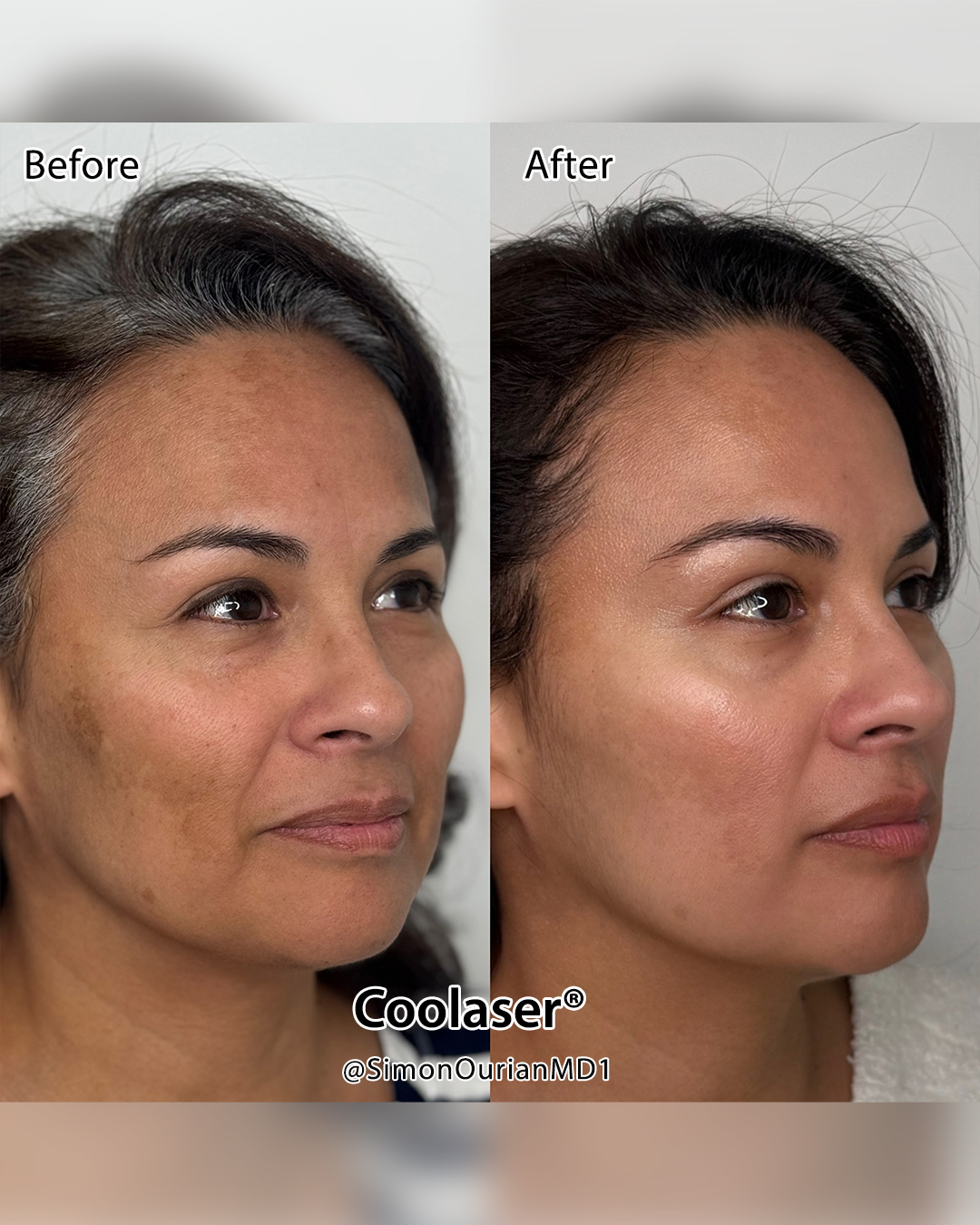 Dr. Simon Ourian - Epione Facebook ad: Coolaser is an advanced non-surgical laser treatment…