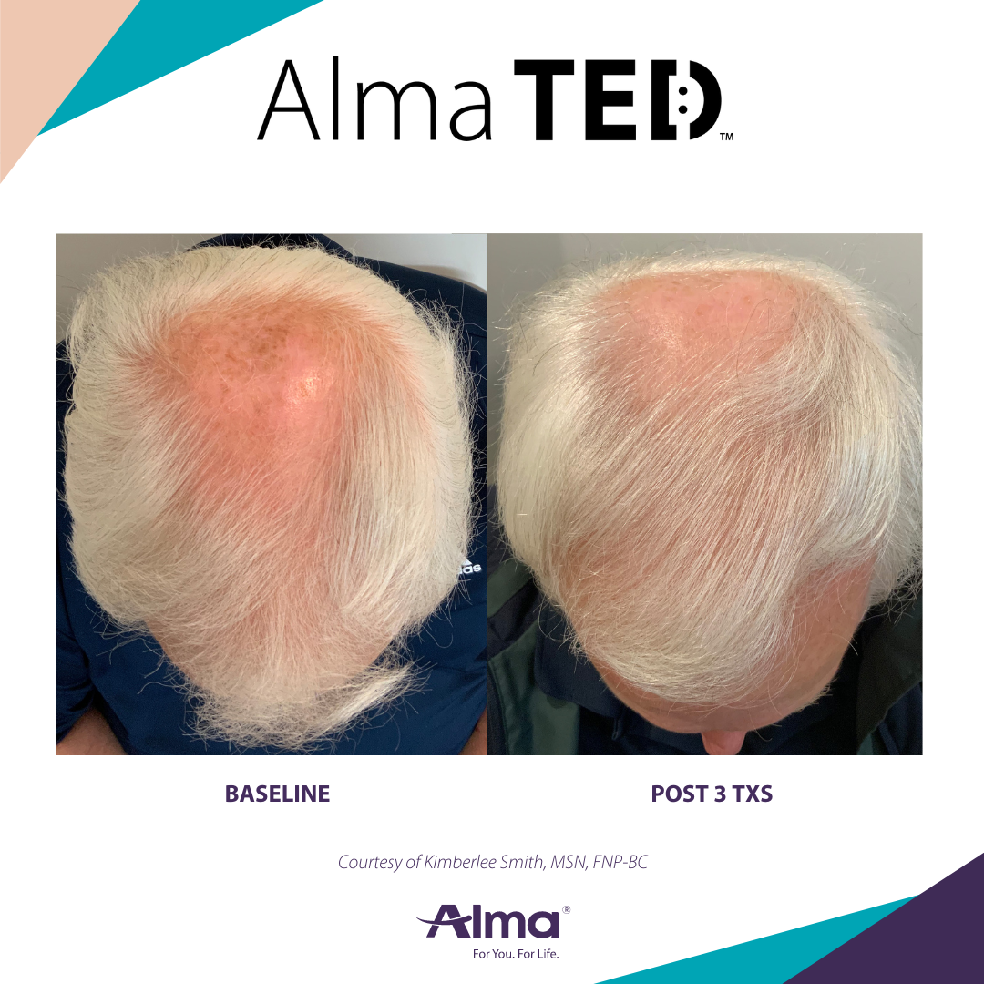 Elite Aesthetics & Medical Care, LLC Facebook ad: Hair thinning rarely gets better on its own…