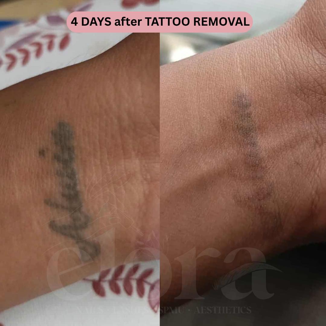 Elora Beauty Facebook ad: Tattoo Removal starts at ₱1,500 per session!
