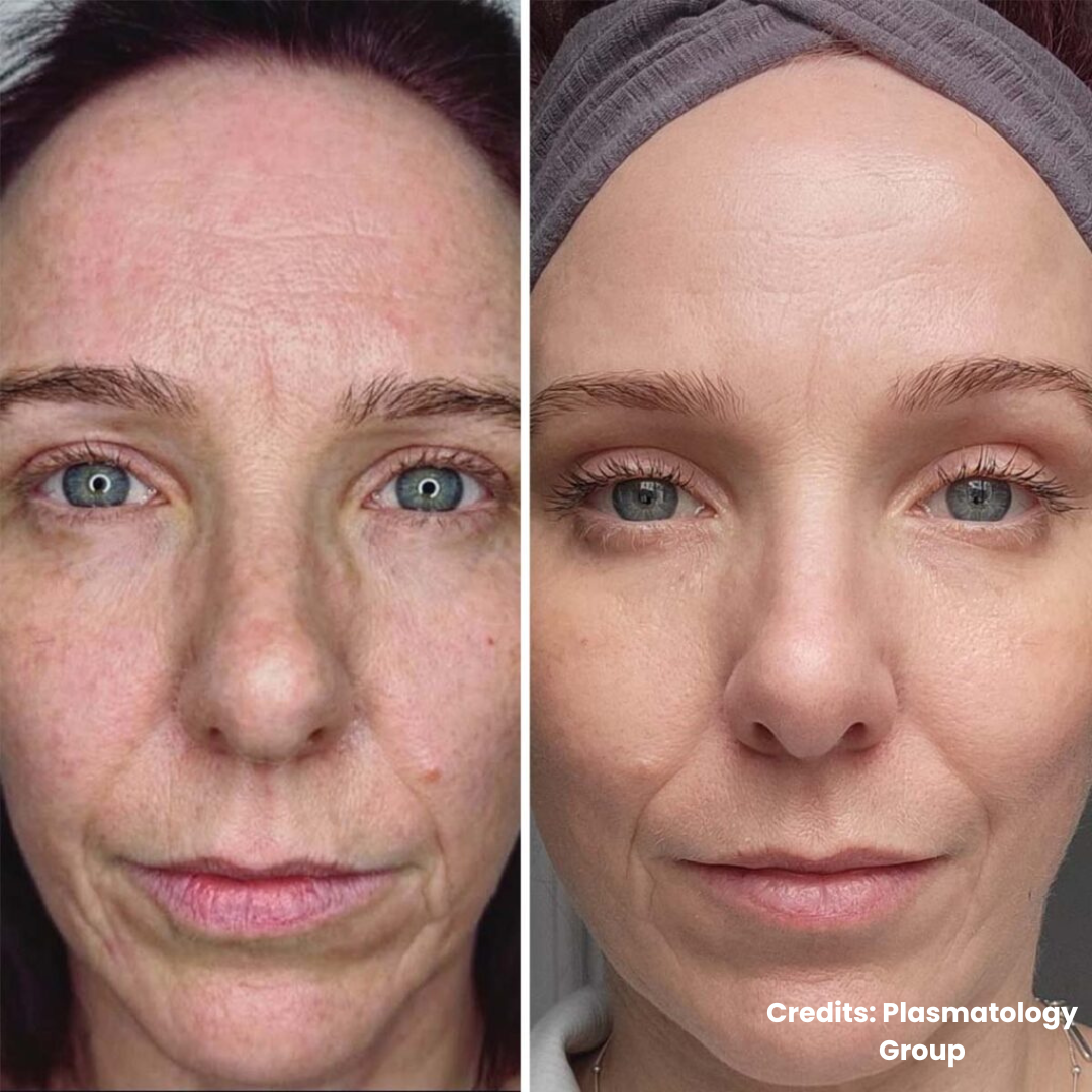 sn_aesthetic_solutions Facebook ad: NeoGen | Full Face and Neck | Now Only £499! (Usually £950)