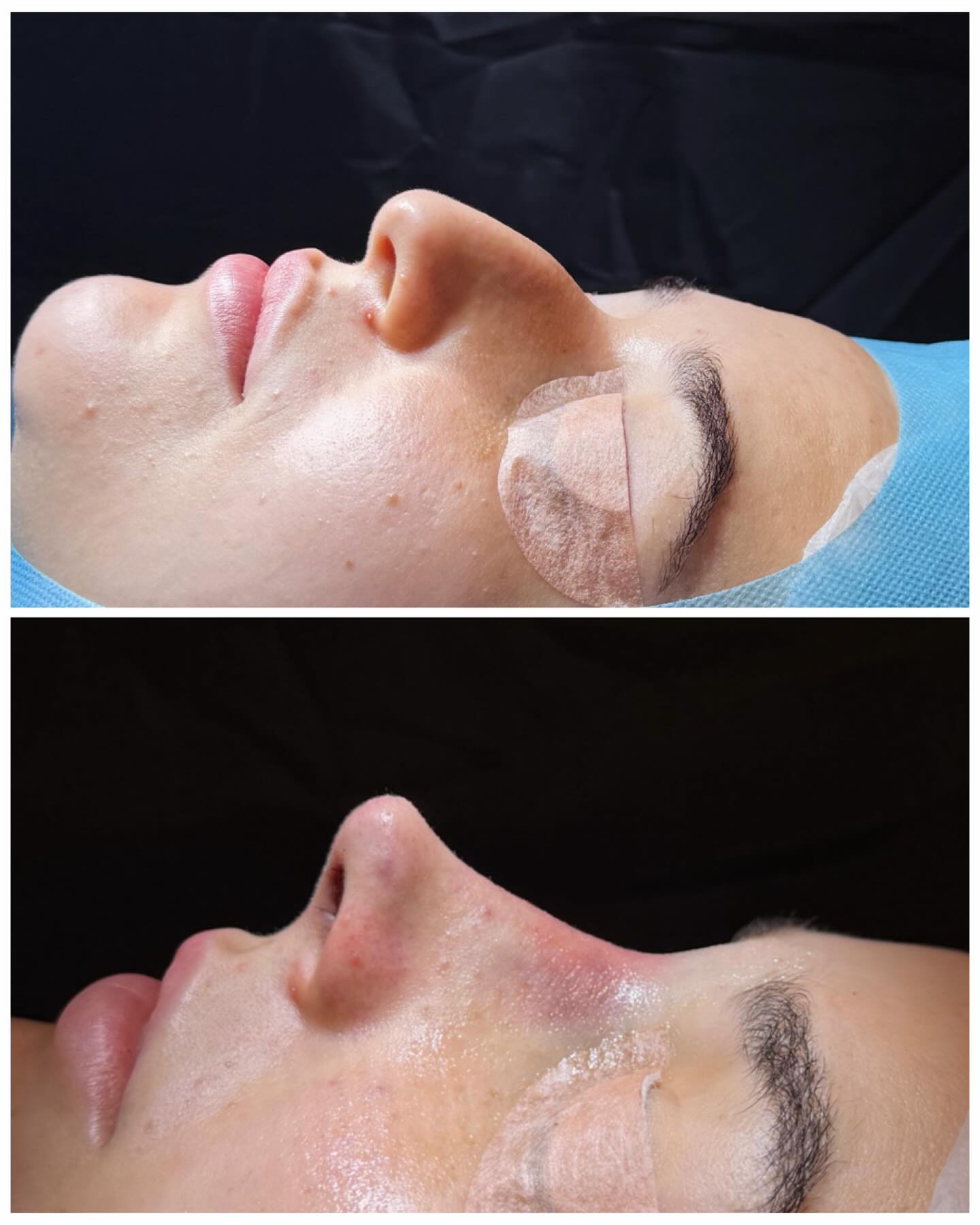 Dra Tammy Torres Facebook ad: Rinomodelação Estruturada avançada