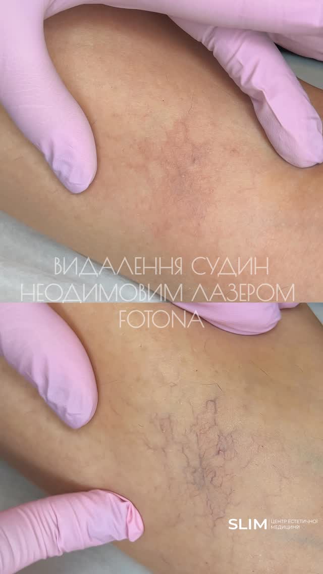 Центр естетичної медицини Slim Facebook ad: Видалення судин Неодимовим лазером Fotona в…