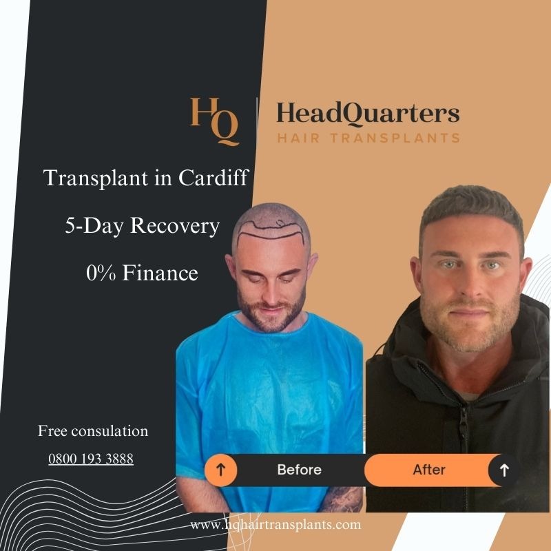 HQ Head Quarters - Hair Transplants Facebook ad
