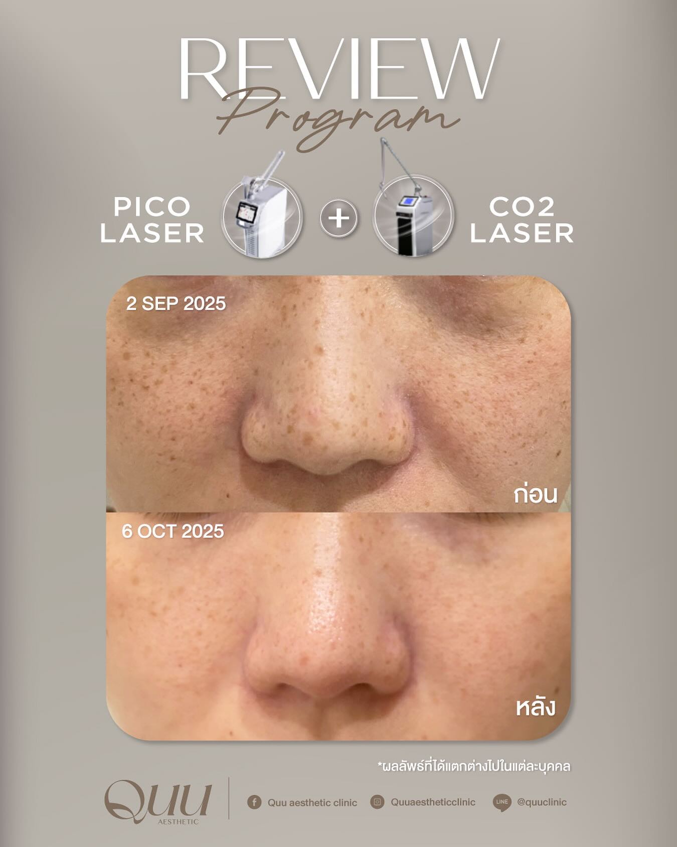 Quu aesthetic clinic Facebook ad: No caption needed!
