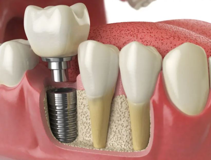 DeVaney Dentistry Facebook ad: From single-tooth to full-arch, DeVaney Dentistry handles…