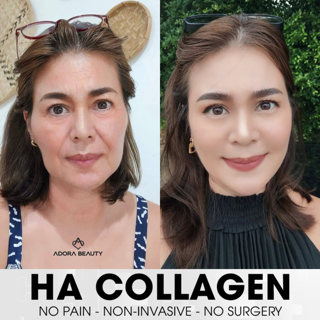 ADORA International Aesthetic Institute - Manila Branch Facebook ad
