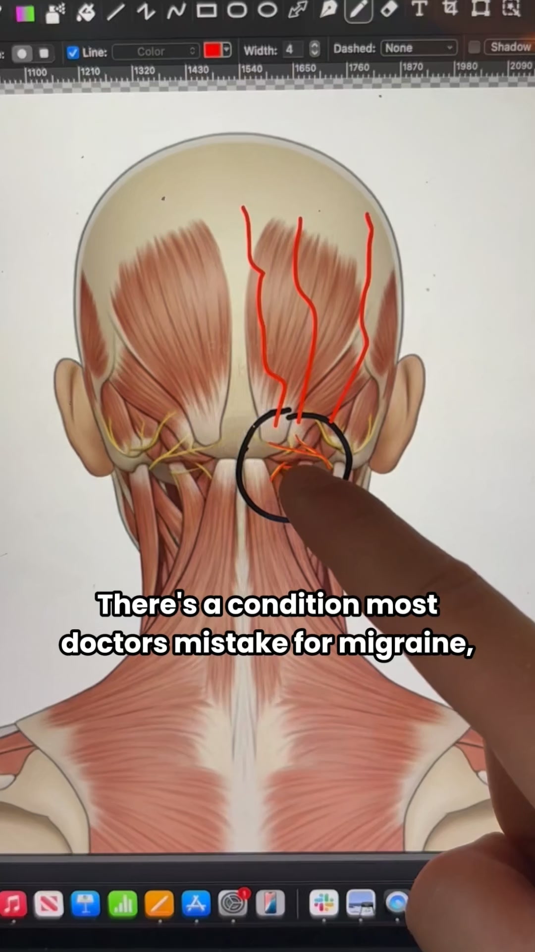 Artuvate Facebook ad: The truth about base of skull pain