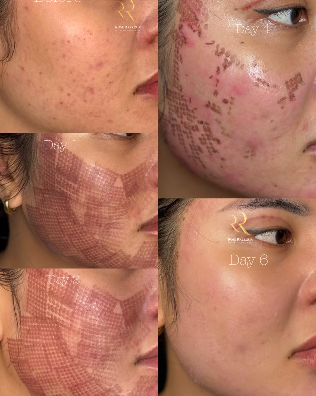 Rose Razzouk Aesthetic Center Inc. Facebook ad: 360 super fractional laser treatment | Skin resurfacing