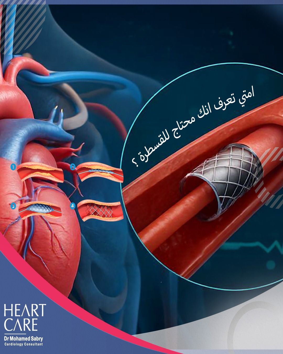 د/ محمد صبري الحديني - استشاري القلب والقسطرة - Dr Mohamed Sabry Alhadainy Facebook ad: امتى تعرف إنك محتاج قسطرة؟