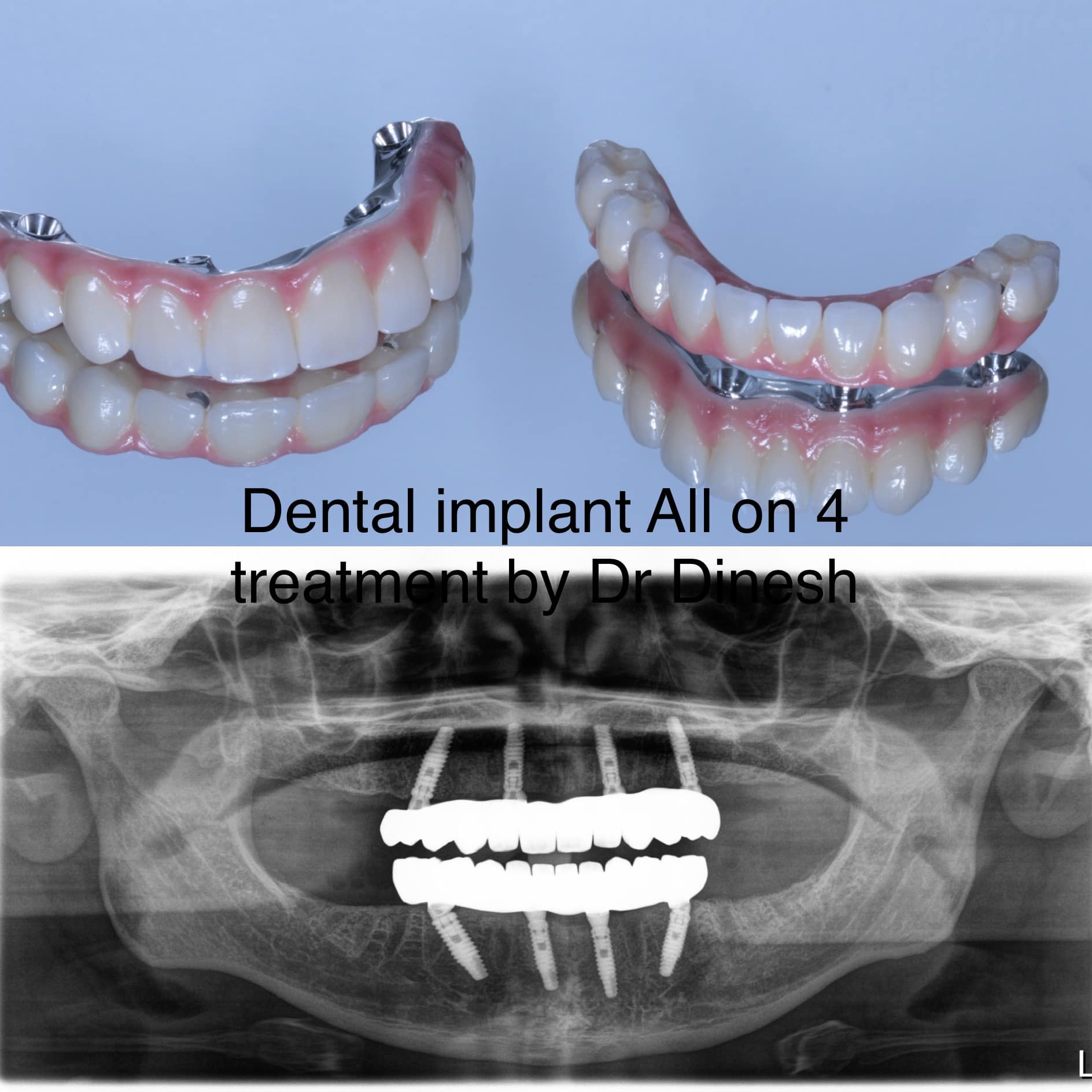 Absolutely Dental Facebook ad: Fixed implant supported dentures may be an alternative…
