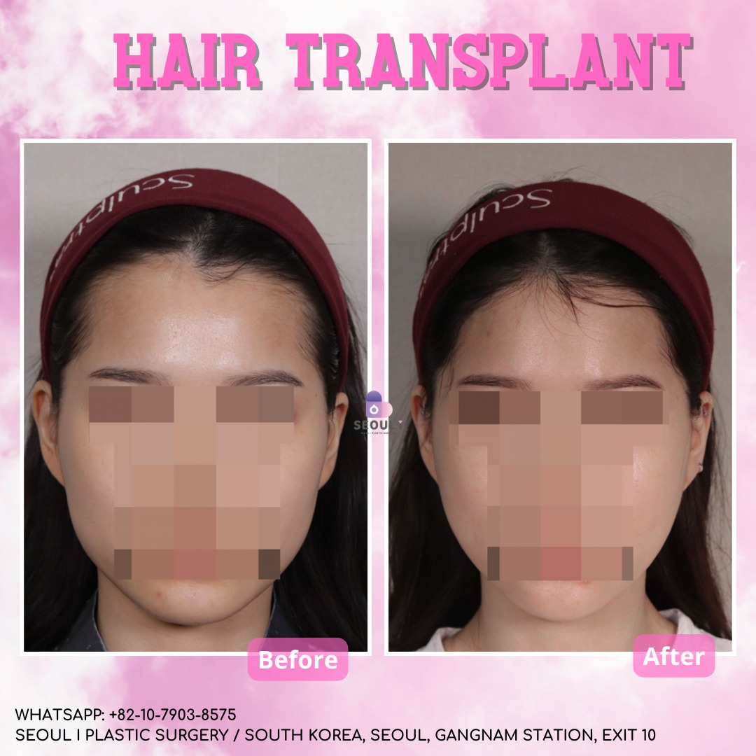 Seoul I Plastic Surgery ENG Facebook ad: Rediscover Your Beauty, Hair Transplant for Women
