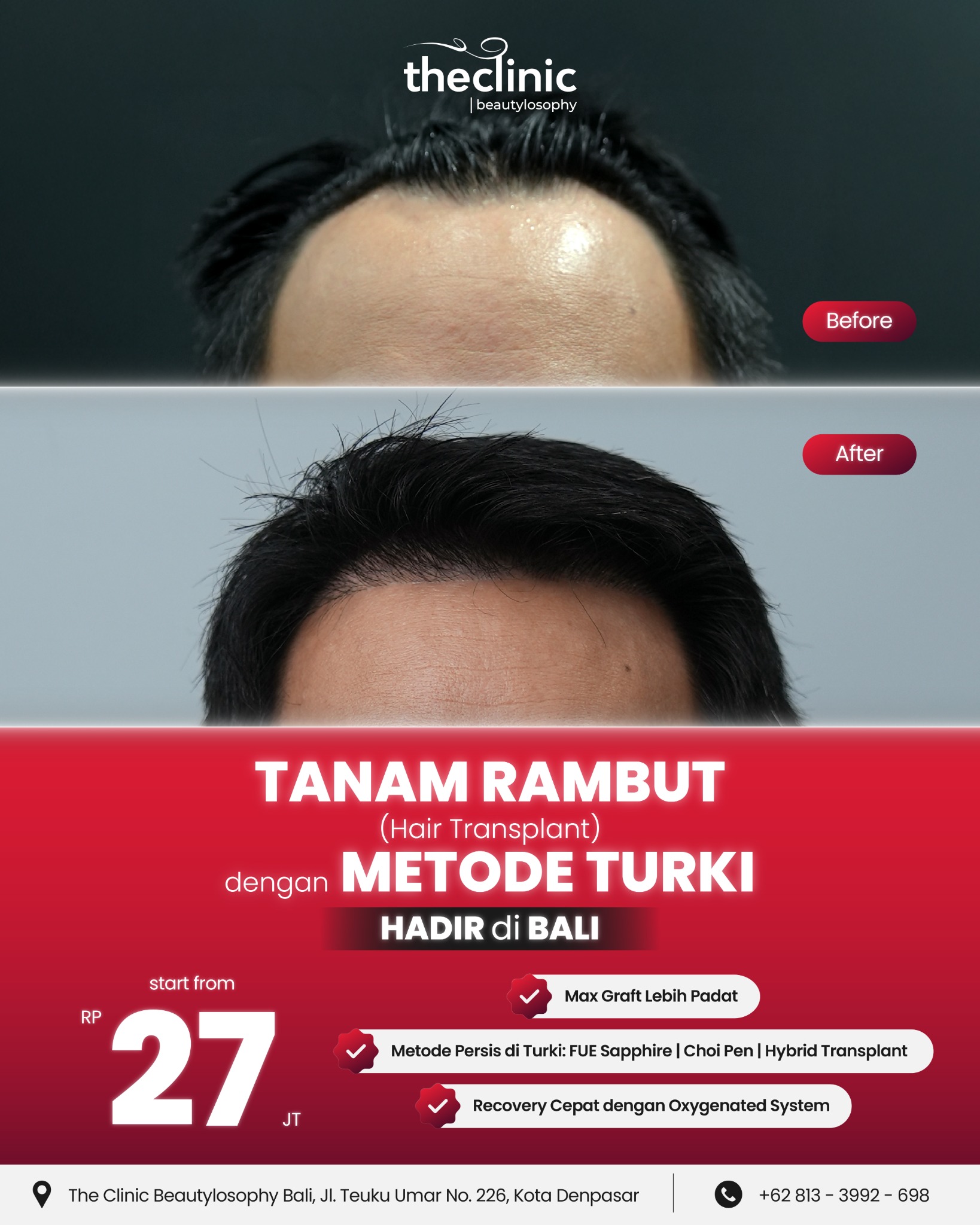 The Clinic Bali Facebook ad: Hair Transplant Metode Turki Kini di Bali!