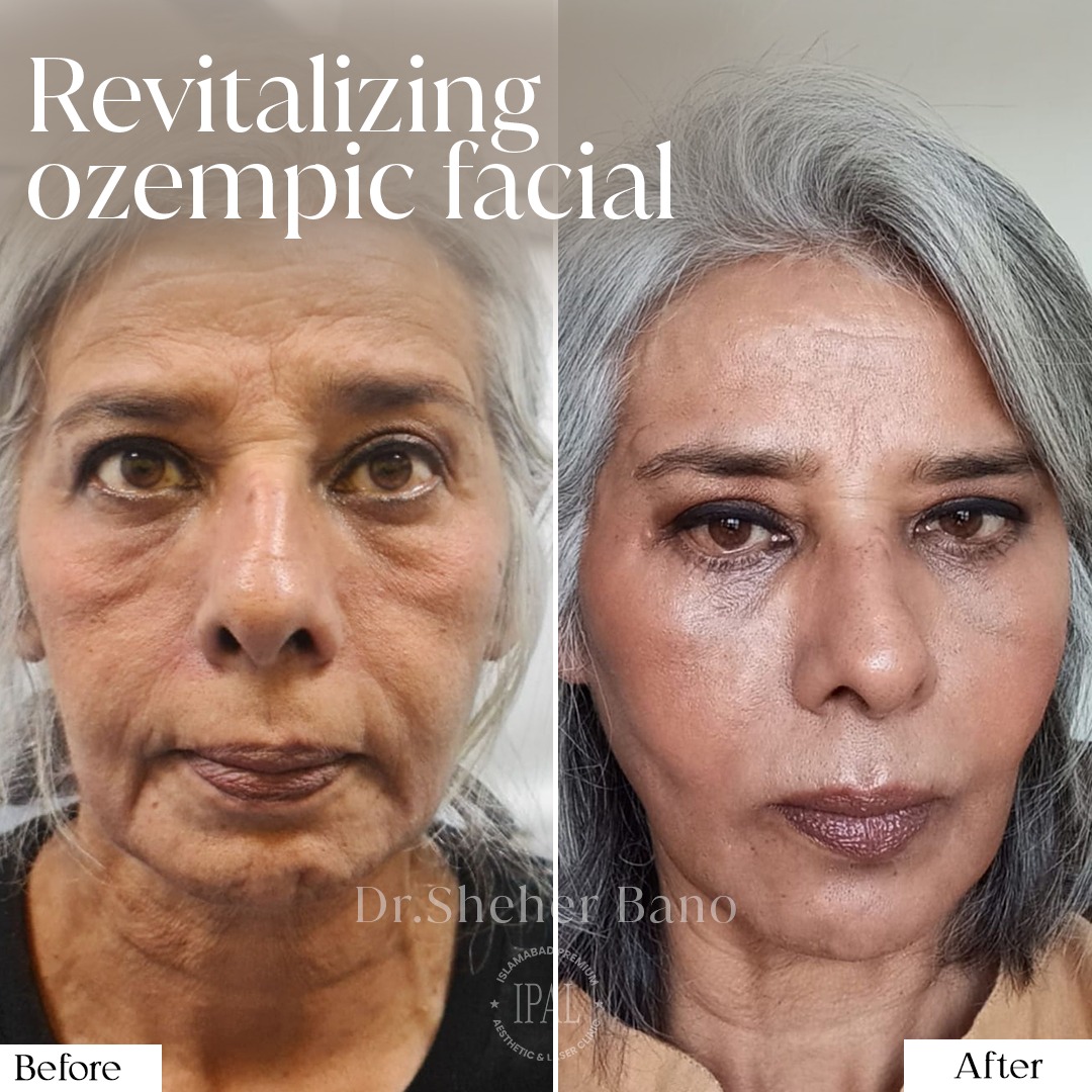 IPAL Clinic Facebook ad: Revitalizing Ozempic Faces (non surgical )