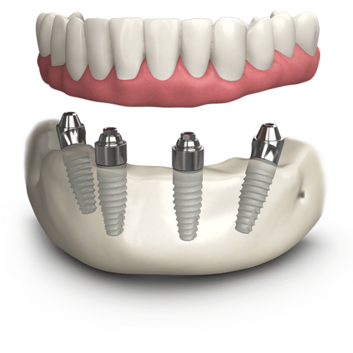 J&B Dental Group Facebook ad: Get Dental Implants from Just £62/month