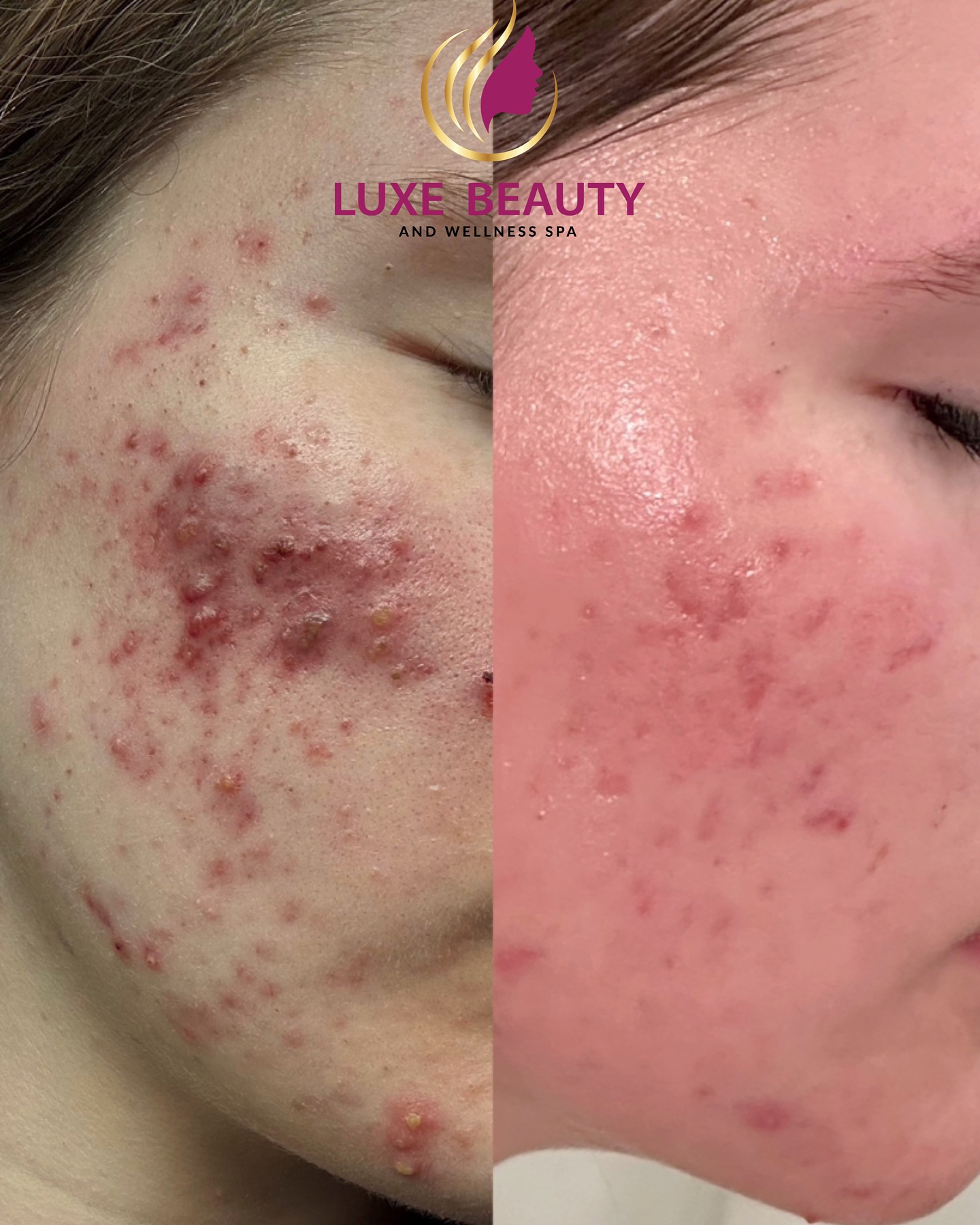 Luxe Beauty and Wellness Spa in Mississauga Facebook ad: Amazing Results for Our Client!