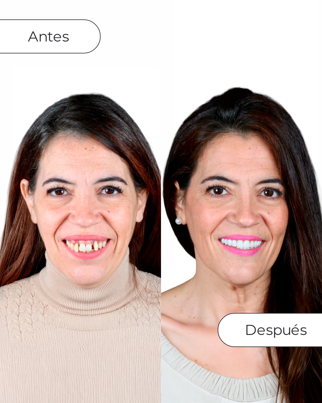 Vericat Implantología Inmediata. Clínica de implantes dentales. Facebook ad: Diana llegó a Vericat Madrid con una situación…