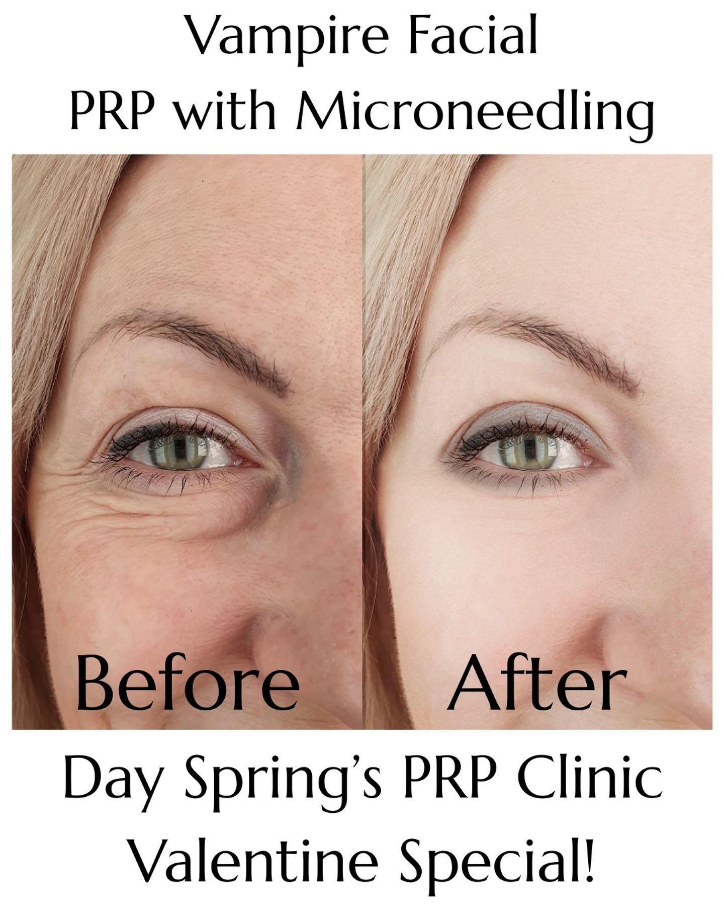 Day Spring Wellness Center Facebook ad: Vampire Facial | PRP | Microneedling