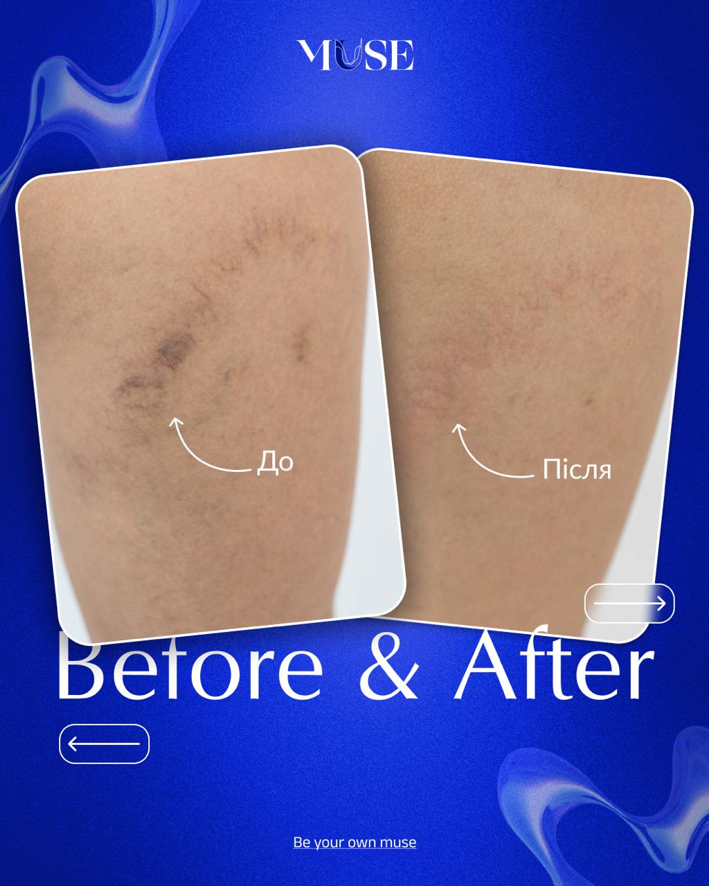 Muse clinic Facebook ad: Судинні зірочки на ногах, це не дрібниця.