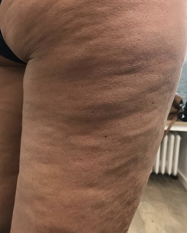 Anastasia Facebook ad: Für alle mit Cellulite trotz Training