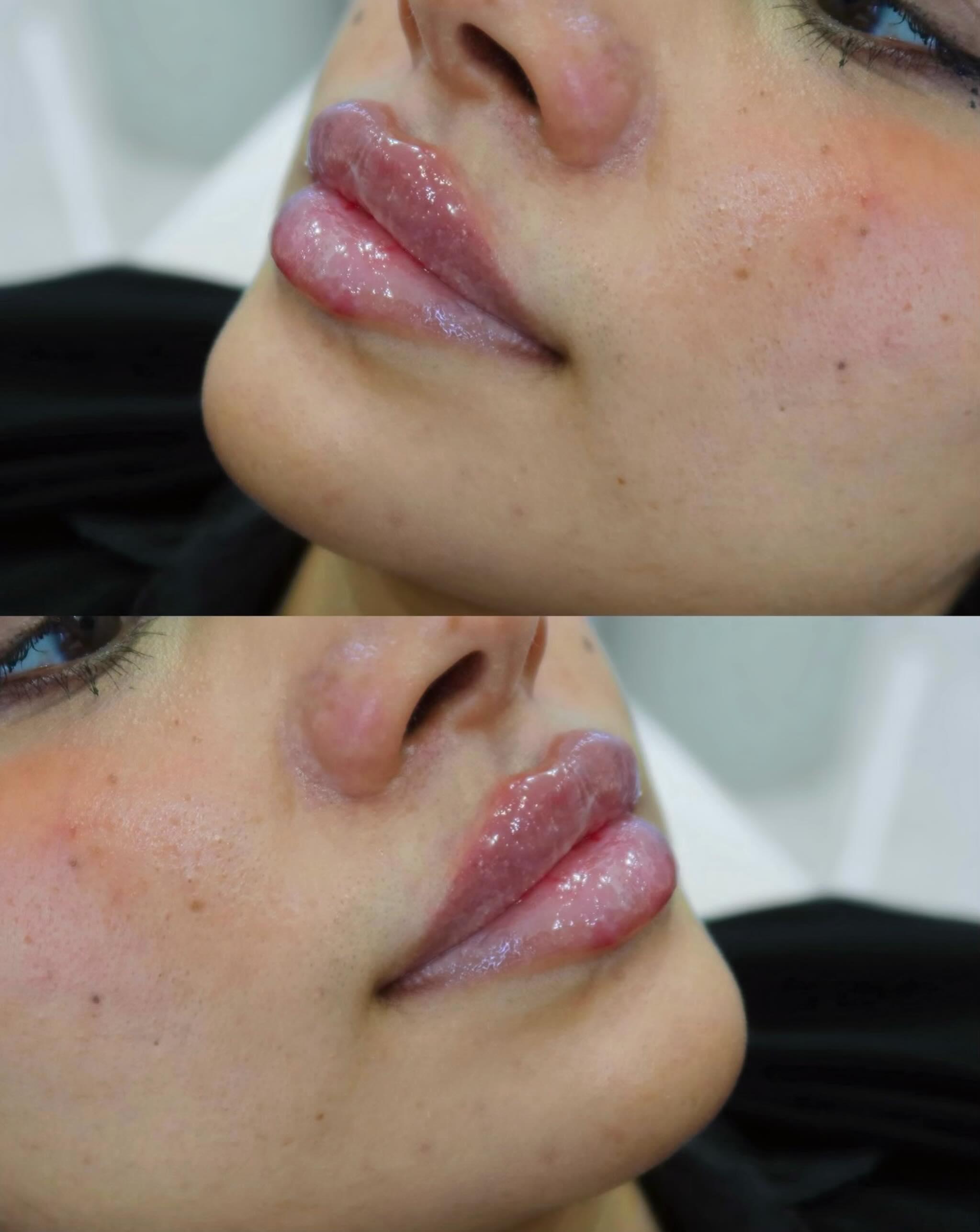 glosclinic Facebook ad: Summer Lips: one of our favourite treatments for…