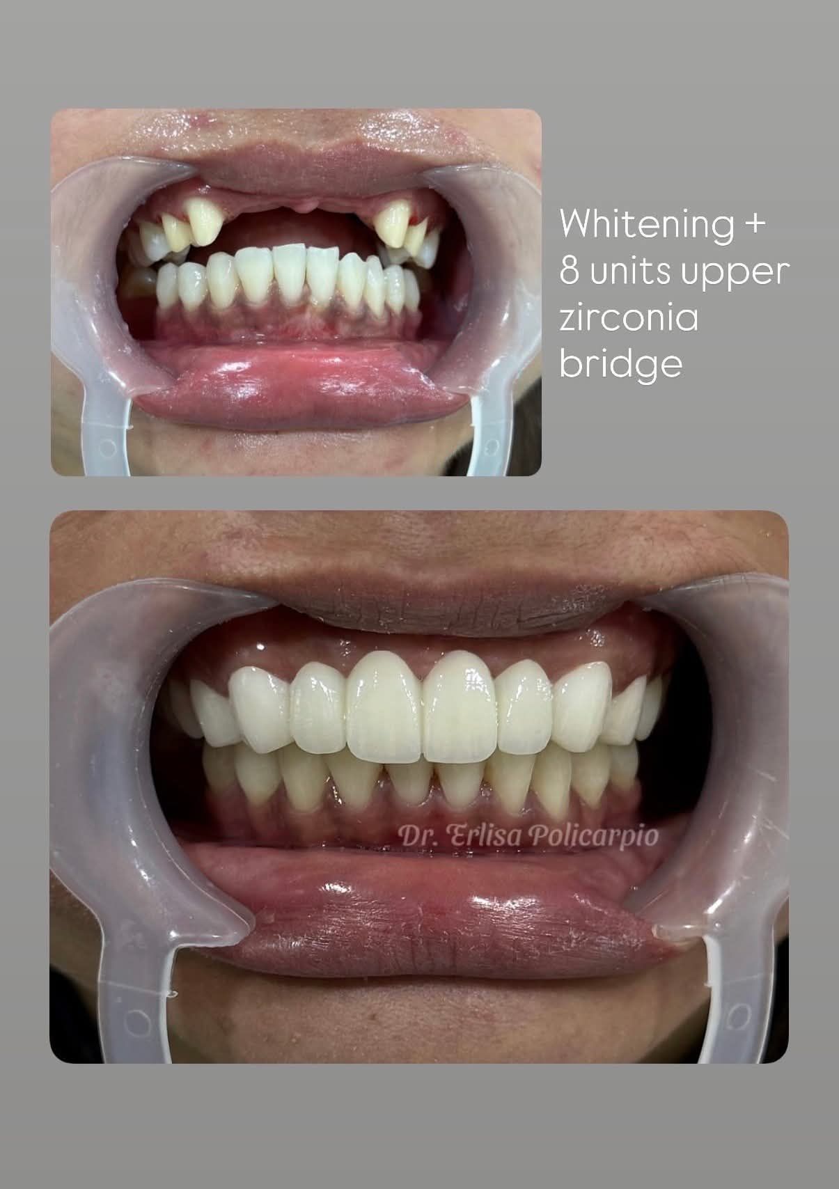 PMDCaL Lucena Facebook ad: Zirconia Upper part