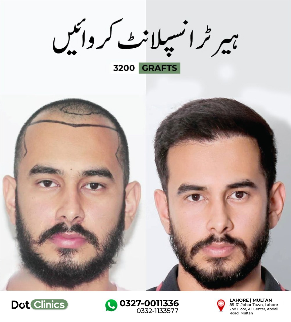Dot Hair Transplant Clinics Facebook ad: Best Hair Transplant | By Plastic Surgeon