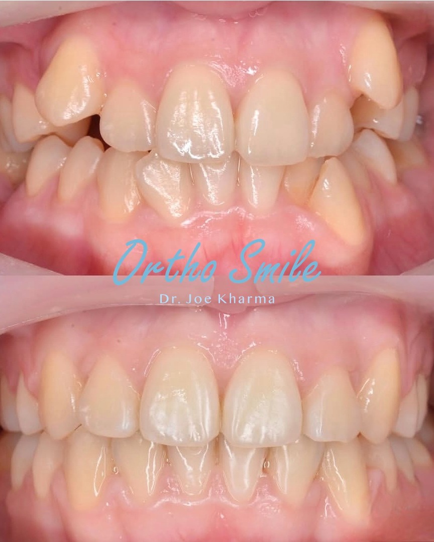 Ortho Smile Facebook ad: This is what real correction looks like… not…