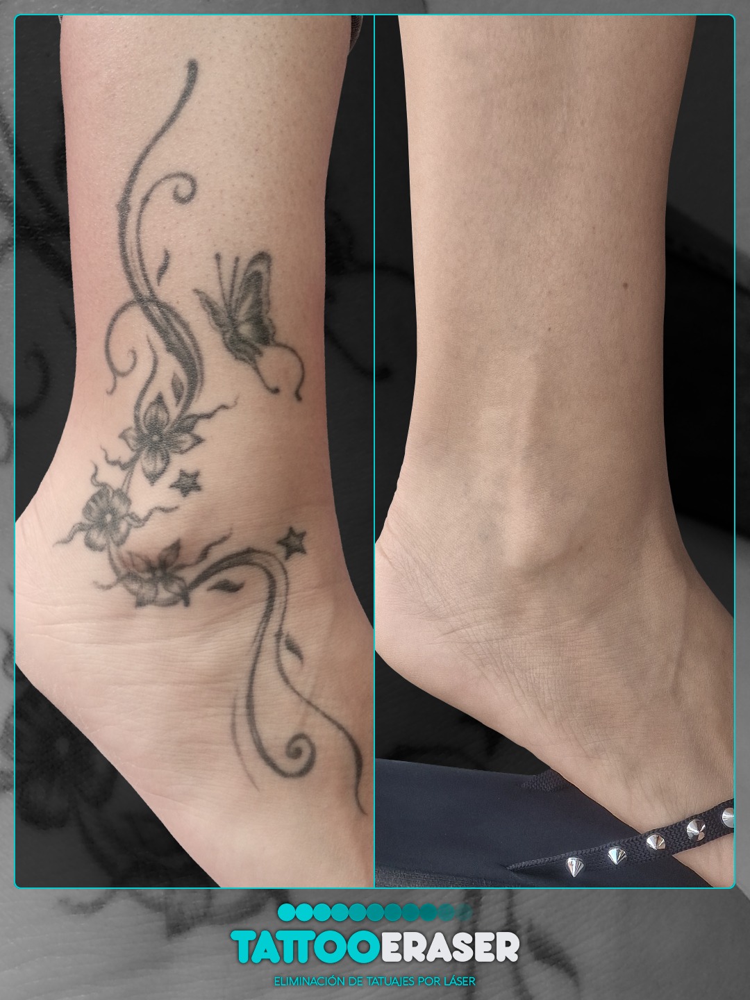 Tattoo Eraser Facebook ad: Ejemplo de eliminación completa en el tobillo.