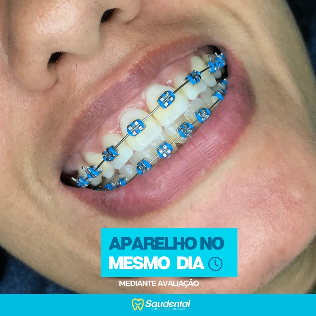 Saudental Recife Facebook ad: Sorriso alinhado é AQUI na Saudental em Recife!