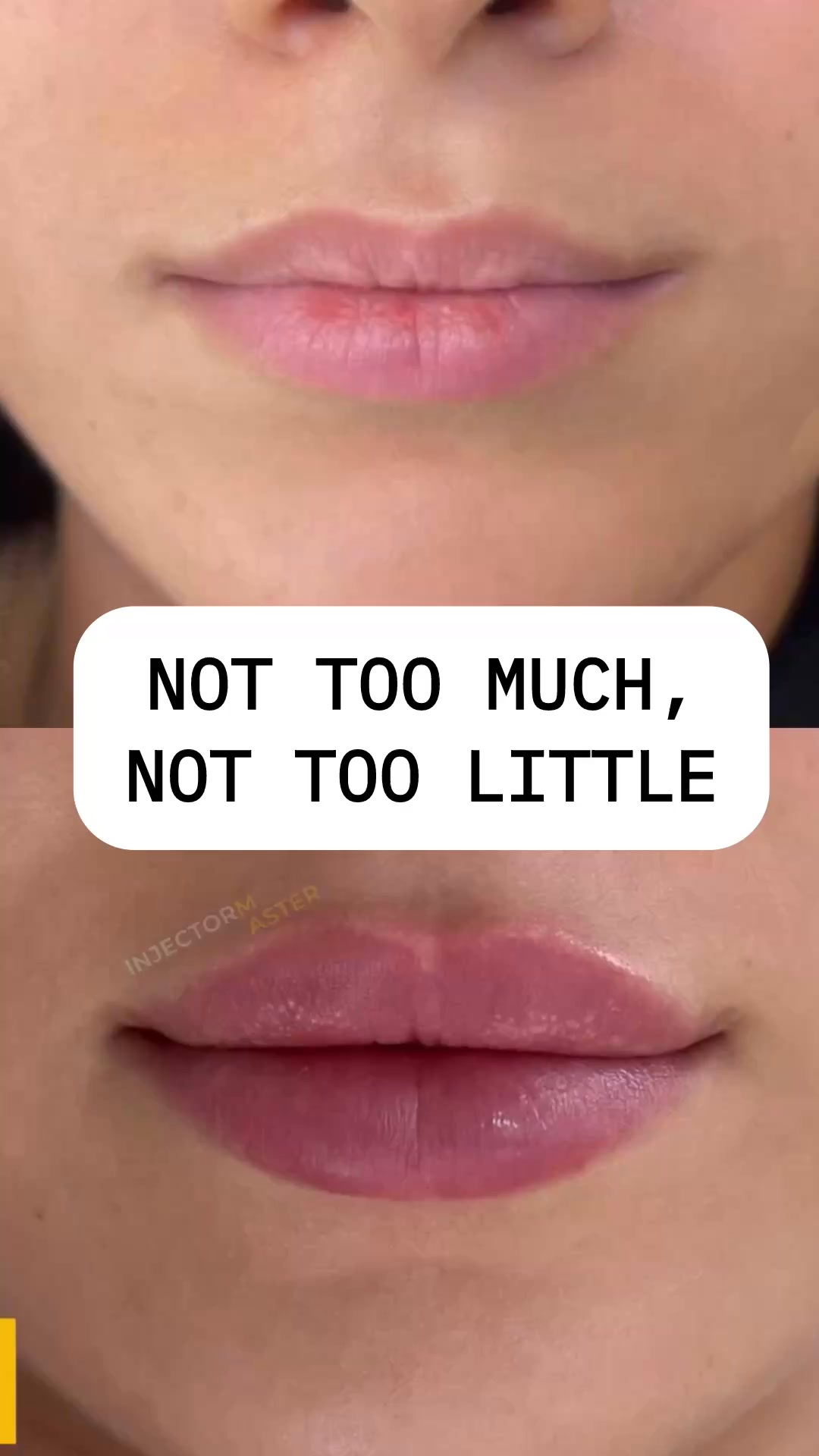 Alena Pelag Dubai Facebook ad: Lip fillers that enhance, not change.